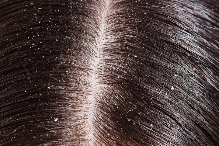 Scalp & Dandruff Analysis